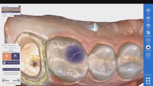 Medit i500 margins from dental intra-oral scanner