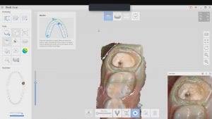 margin marking with native Medit i500 scan