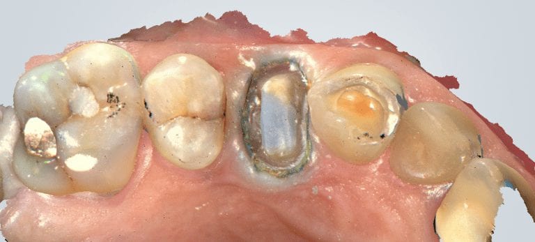 Our First Shining 3D Aoralscan Case- A Preview