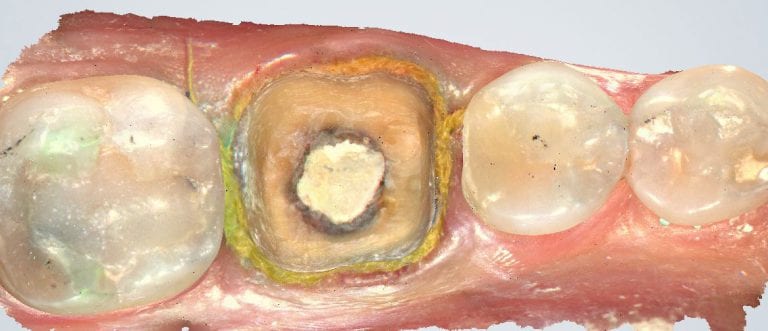 Shining 3D AoralScan Margins