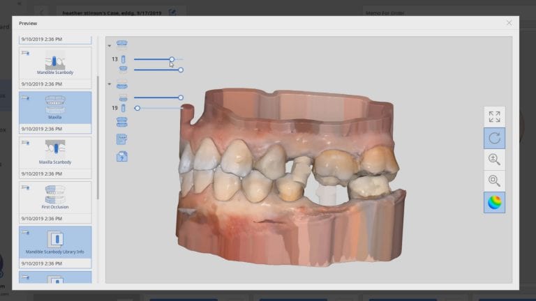 Upper Tibase and Lower Custom Abutment Scanbody Optical Impressions Made with Medit i500 Artificial Intelligence