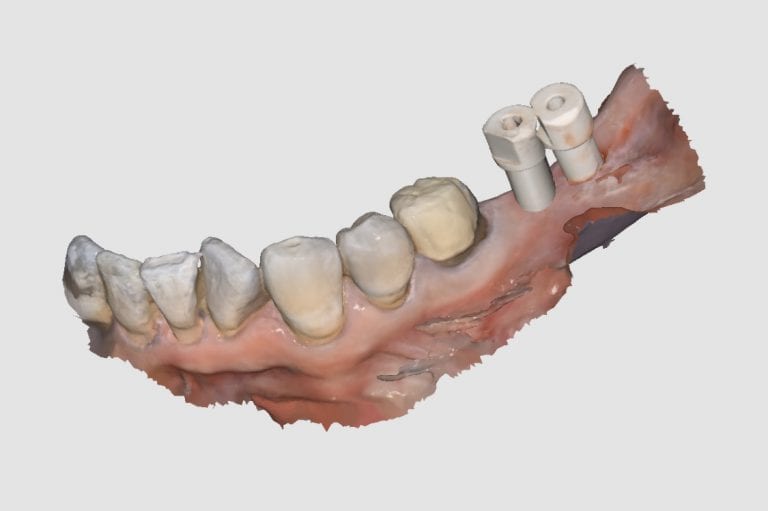 Implants and Digital Impressions