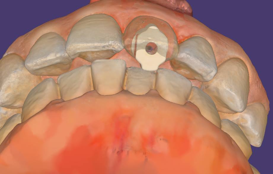 dental implant scanbody used by the medit i500