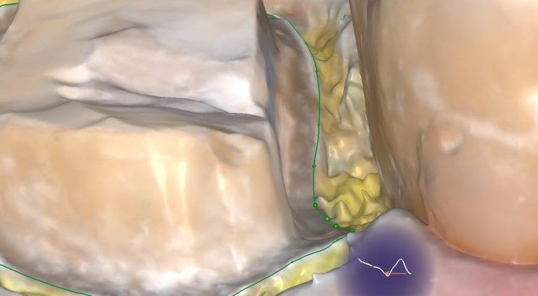 Tissue Displacement Flash for Analog Impressions vs FLUSH for Digital Impression