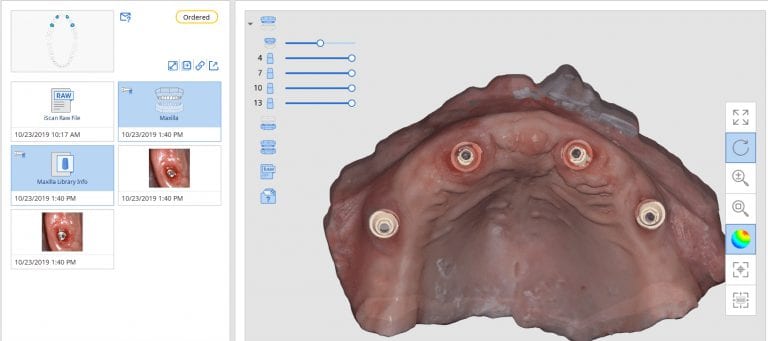 Using Medit i500’s Artifical Intelligent Implant Suprastructure Identification System to Find Multi-Abutment Margins