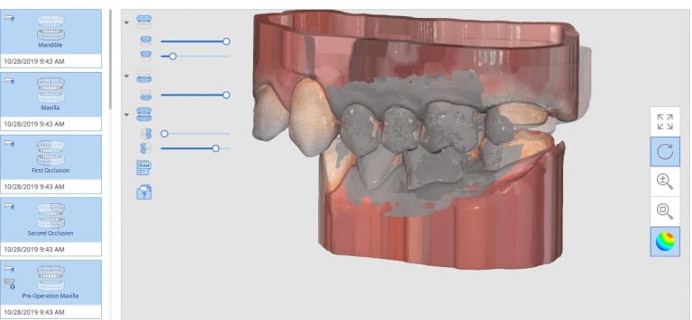 Distal Extension Second Molar Crown Replacement in Copy Mode and With Two Bites