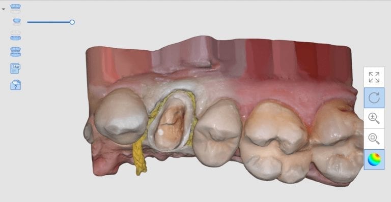 A Premolar Crown With the Medit i500, exocad, and Coritec ONE
