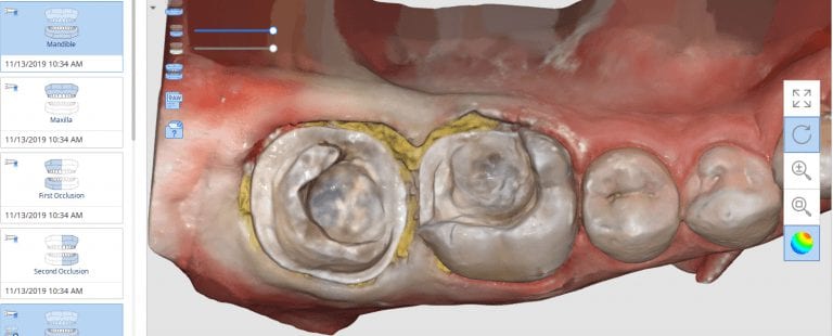 Exposing and Correcting the Distal Margin Scan