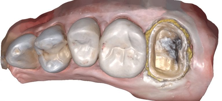 A Simple Crown Copy Case With Medit i500