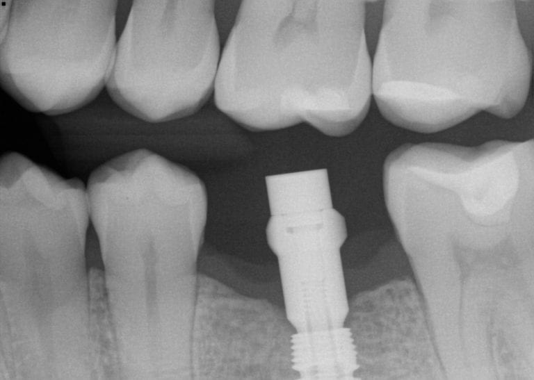 Proper Implant Placement and Digital Impressions with Scanbodies and Medit i500 Lead to Predictable Results