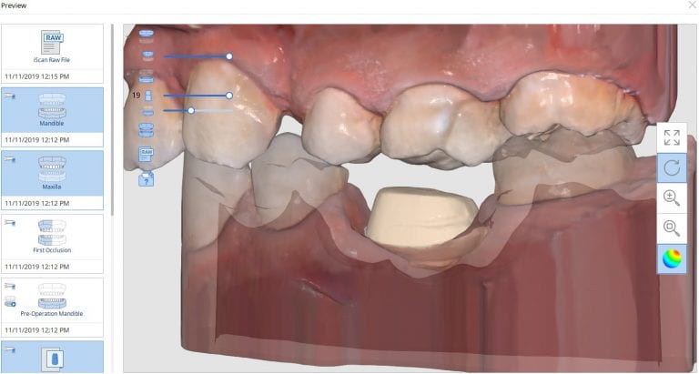 Implant Margins Impressions Performed Extra-Orally With The Medit i500