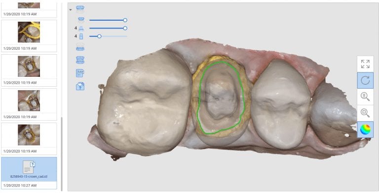 Proper Retraction and Isolation Leads to Great Marginal Fit
