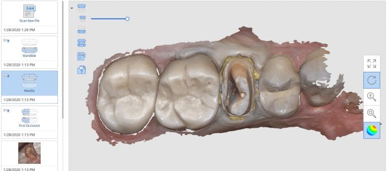 Premolar Crown with Medit i500, Meditlink, exocad, Amber Mill Block, Coritec One by Imes Icore, and Millbox CAM Software