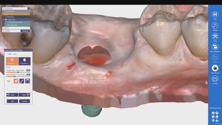 Single Implant Scanbody Digital Impression with the Medit i500 Intra-Oral Scanner