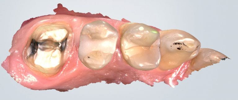 Upper Right First Molar Scanned with the Shining 3D Intra-Oral Scanner for Beginners