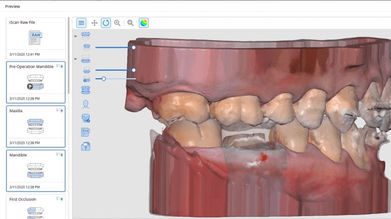Imaging a deep margin with the Medit i500