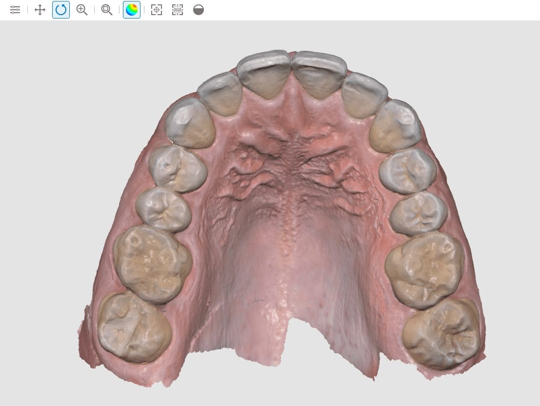 Can you use an intraoral scanner for upper jaw impressions