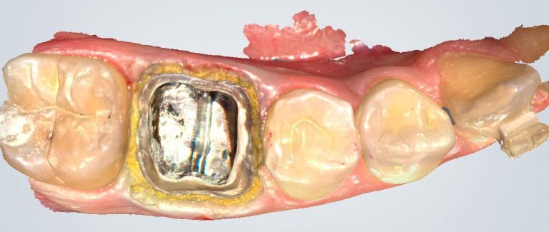 Lower First Molar Deep Margins Scanned by Shining AoralScan