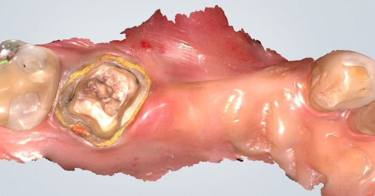 Shining 3D Aoralscan Sample Meshwork