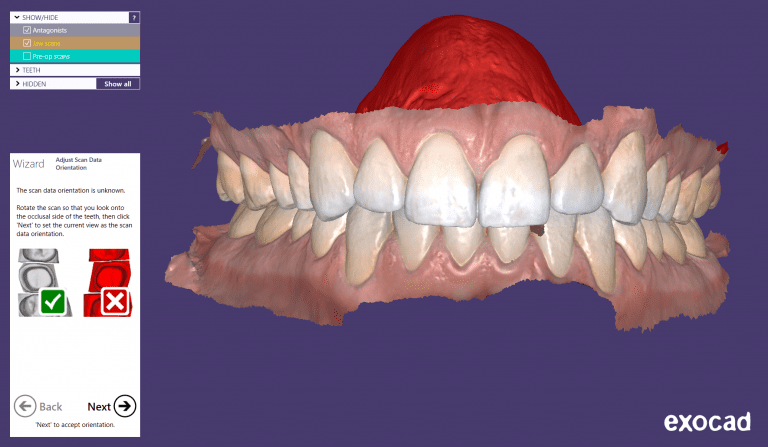 Intraoral Scanning: The Basics & How It Works