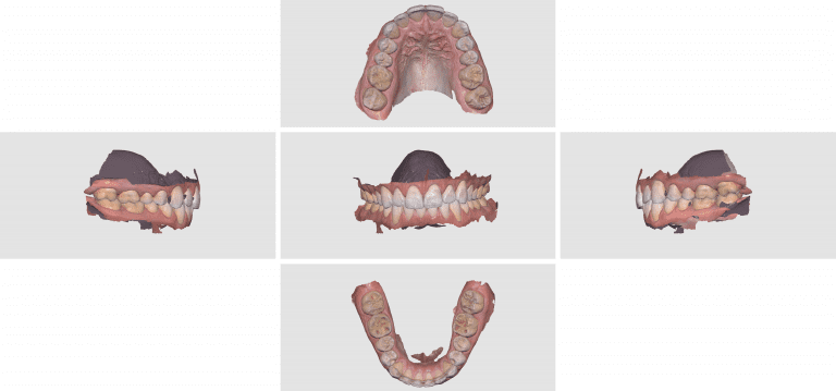 How To Offer Digital Clear Aligner Therapy