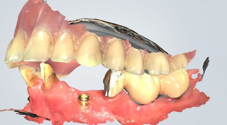 Virtual Extractions for Overdenture with Shining 3D