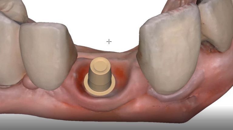 Milling Tibase Crowns to CEREC MCXL with a Medit Scan and exocad design software