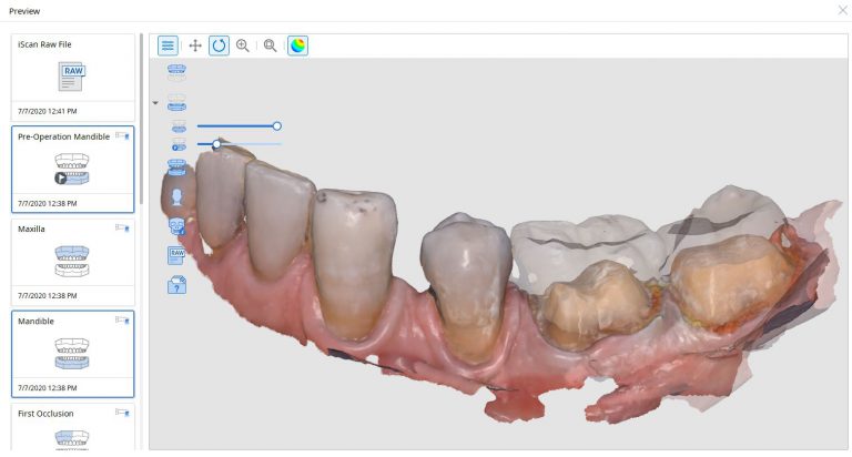 Two distal extension molar crowns and one milling machine for single visit dentistry