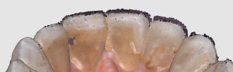 The difference between difficult areas to access and scan with an intra-oral scanner and areas where you are likely to introduce errors in arch accuracy