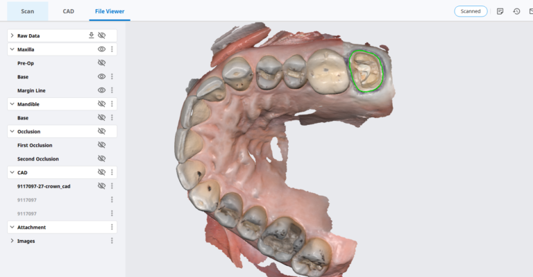 Chairside Milling of Lithium Disilicate with Meditlink 2.3 and Medit Scan