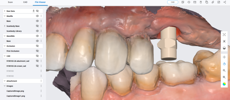 Overview of a Simple Scanbody Capture and Implant Abutment and Crown Design