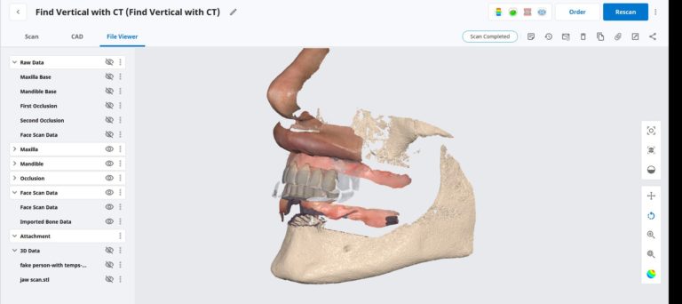 Using the CT as a Remount Jig If You Have Lost The Vertical Dimension For Some Reason or Another