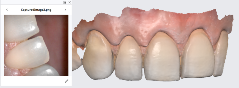 Translucent Enamel Is A MotherDoctor For All Intra-Oral Scanners And Their Accuracy