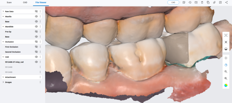 Medit i500; The Easy Entry Into Digital Impressions And CAD/CAM Restorations