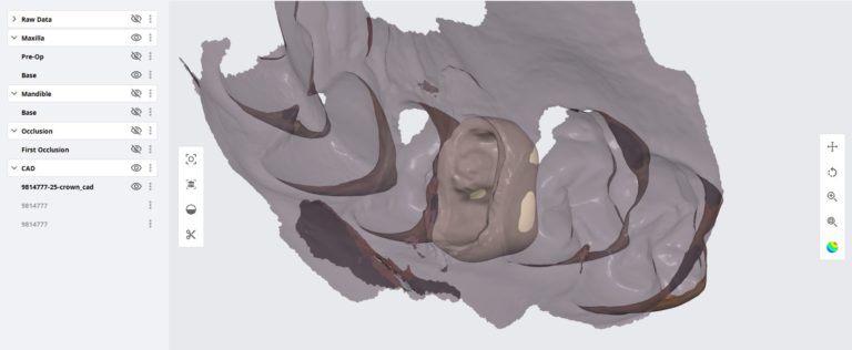 Managing a Crown with a Pair of Class 2 Adjacent Restorations in a Single Visit