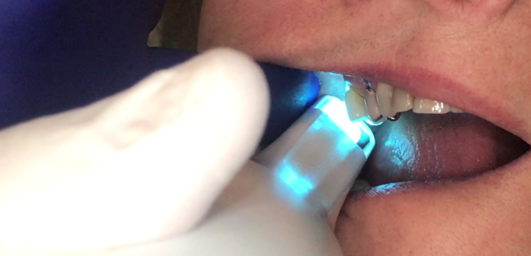 Easy Scan of DistoBuccal Area of Upper Second Molar