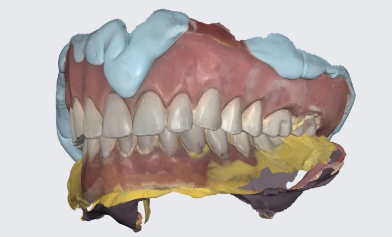 New Overdenture Fabrication from Previous Worn and Broken Overdenture by Medit IOS