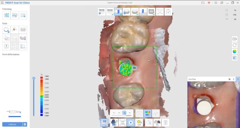 Advanced Features of the Medit i700 IOS That Separate it From All Other Scanners