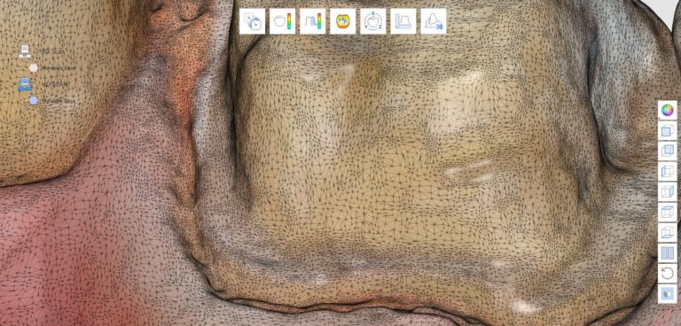 Meshwork in Local HD and RD Scanning