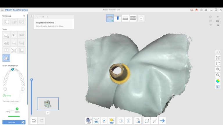 Introducing Medit’s Abutment Registration Feature