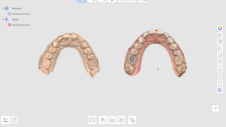 Top Reasons Why Restorations from Digital Impressions Don’t Fit