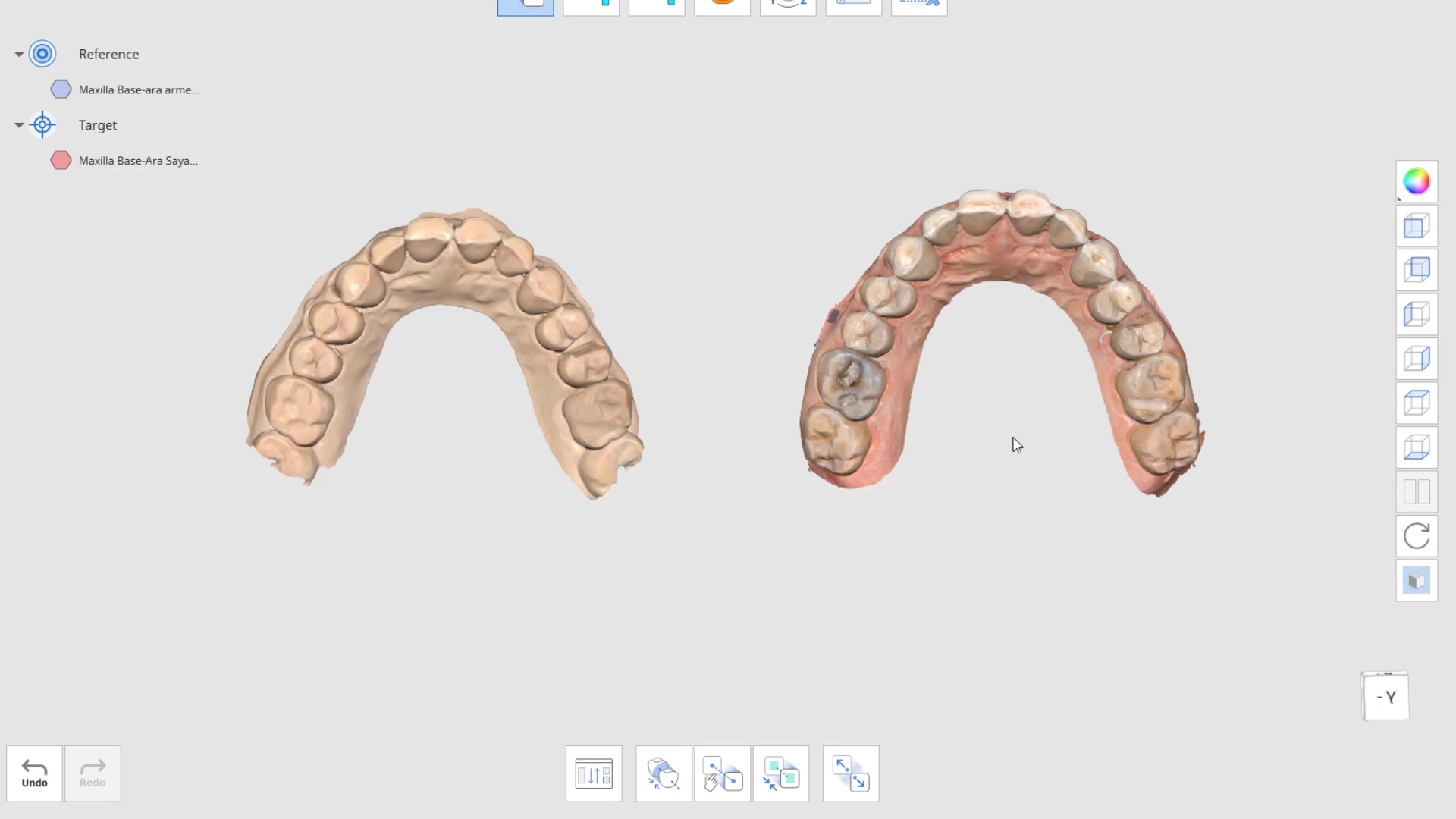 Can you use an intraoral scanner for upper jaw impressions