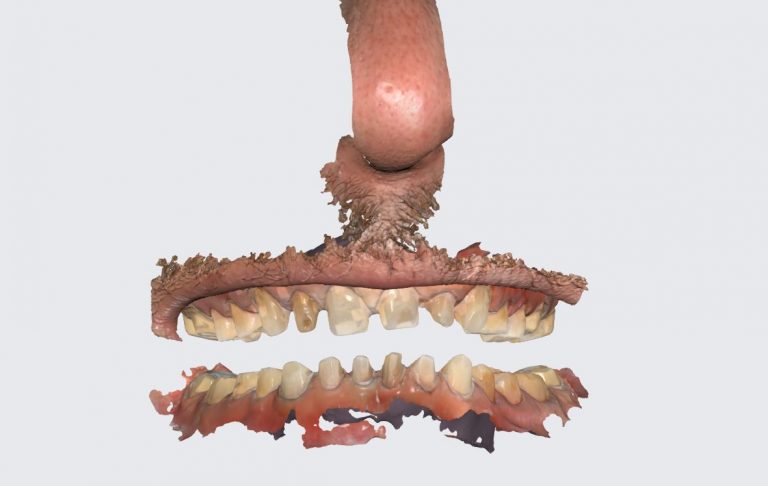 Full Mouth Rehab under Sedation