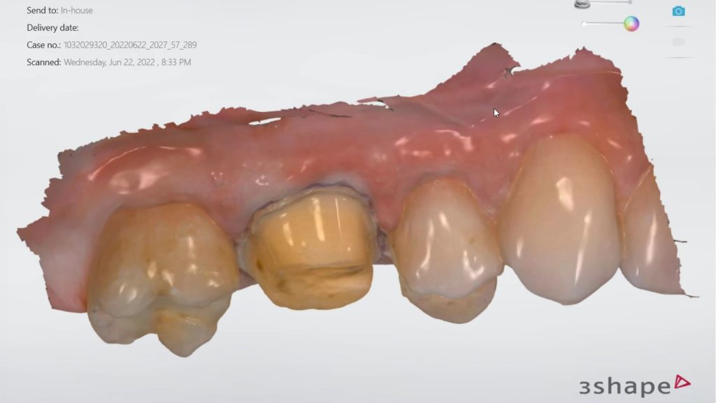 Do NOT use the Double Cord Technique in the Traditional Manner for