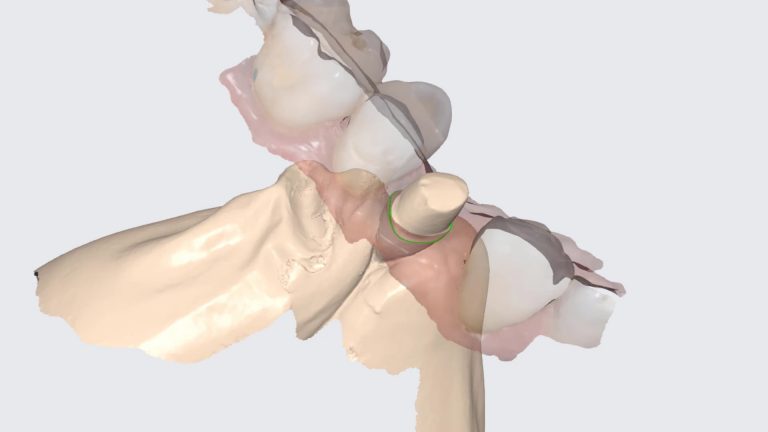 Medit’s Artificial Implant Supra-structure Identification System in Action