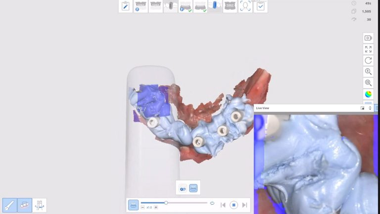 Scanbodies and Edentulous Ridges