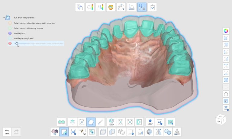 A Preview of the Fastest Way to Design a Large Temporary Prosthesis
