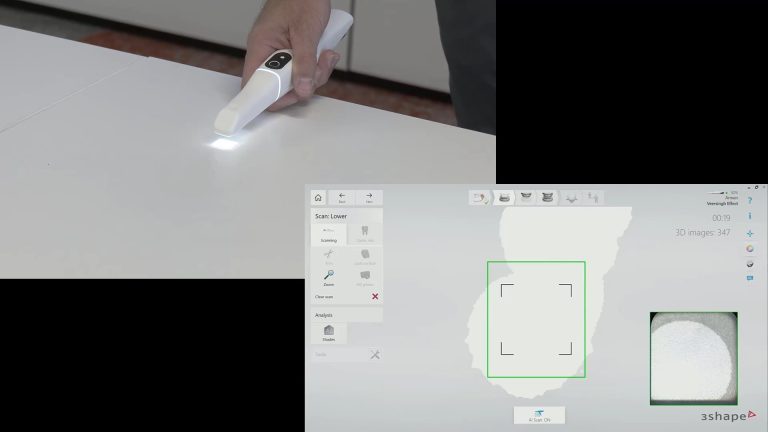“Veersing” Effect – How Intra-Oral Scanners Introduce Errors in Edentulous Jaws and Flat Planes