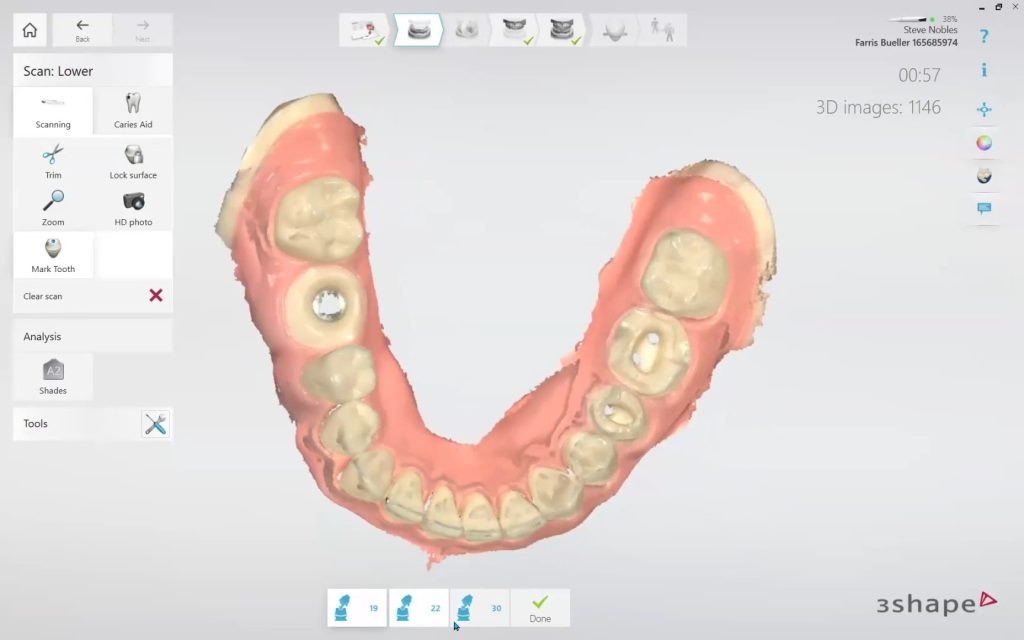 How to Scan Multiple Units and a Scanbody | CAD-Ray.com