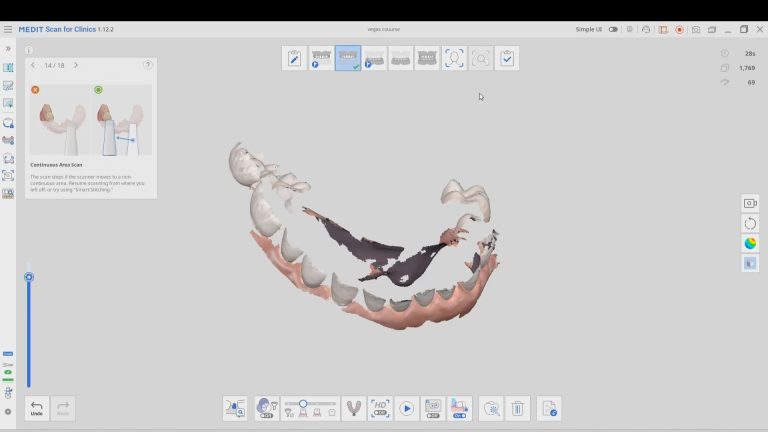 The Field of View is the Holy Grail of Intra-Oral Scanners